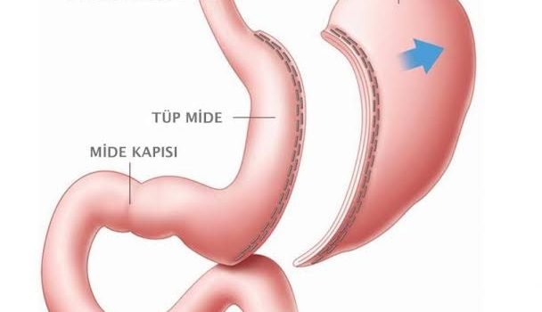 tüp mide ameliyatı